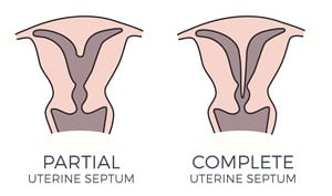 Uterine Septum