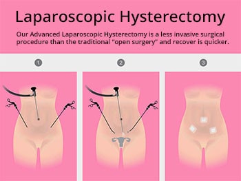 Laparoscopic hysterectomy