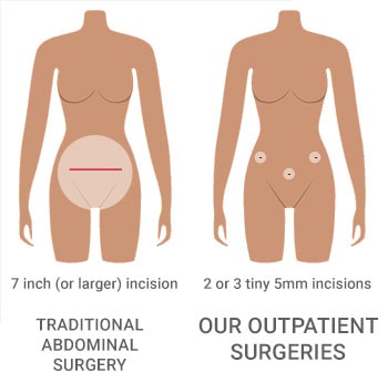 Our laparscopic procedure versus traditional surgery