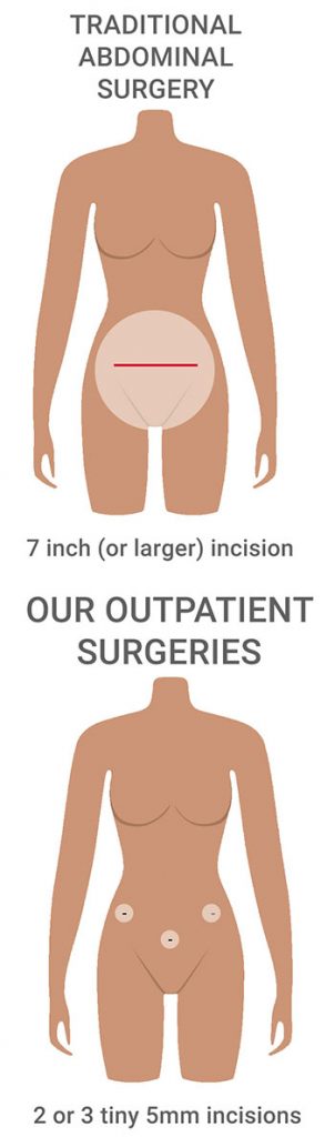 Ooforoplastia e salpingectomia laparoscópica / Oophoroplasty and  laparoscopic salpingectomy (left). 