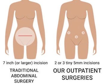 abdominal surgical incisions