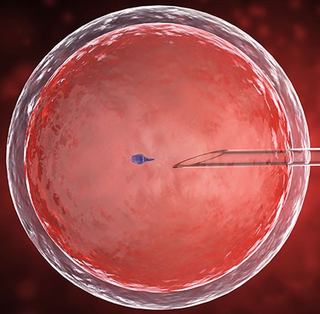 In Vitro Fertilization