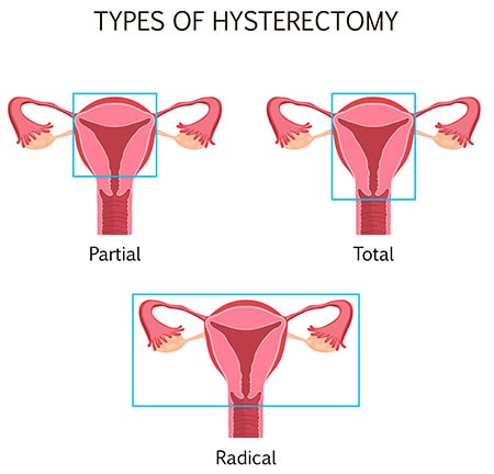 Diagram of hysterectomy types